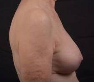 Aesthetic Breast Revision Before & After Gallery - Patient 281728 - Image 6