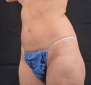 360 Liposuction Before & After Gallery - Patient 305550 - Image 8