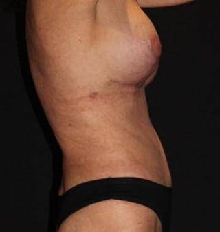 Mommy Makeover Before & After Gallery - Patient 309496 - Image 8