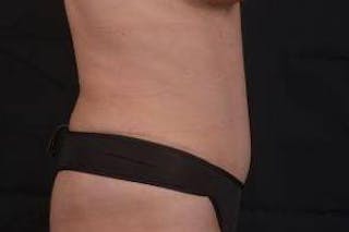 Abdominoplasty Before & After Gallery - Patient 410231 - Image 6