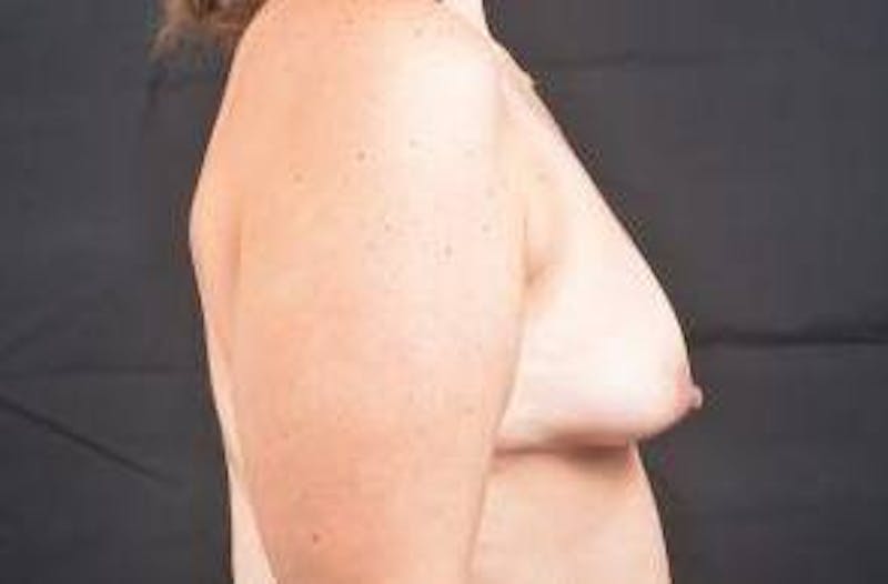 Breast Augmentation Silicone Gel Before & After Gallery - Patient 456880 - Image 5