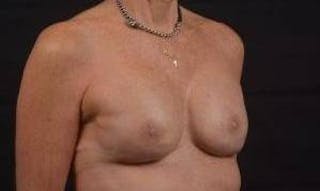 Immediate Breast Reconstruction – Skin Sparing Before & After Gallery - Patient 157047 - Image 10