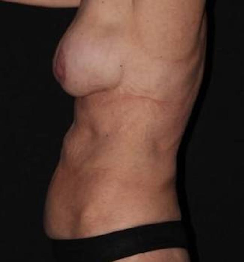 Mommy Makeover Before & After Gallery - Patient 309496 - Image 9