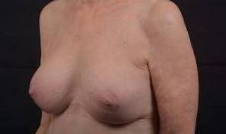 Aesthetic Breast Revision Before & After Gallery - Patient 281728 - Image 8