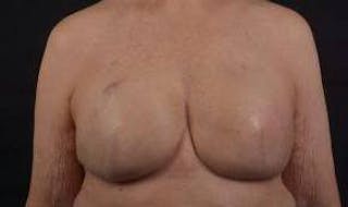 Immediate Breast Reconstruction – Skin Sparing Before & After Gallery - Patient 221455 - Image 2