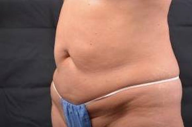 Abdominoplasty Before & After Gallery - Patient 410231 - Image 7
