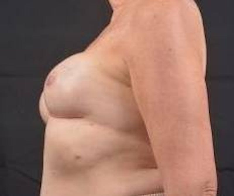 Immediate Breast Reconstruction – Nipple Sparing Before & After Gallery - Patient 118610 - Image 3