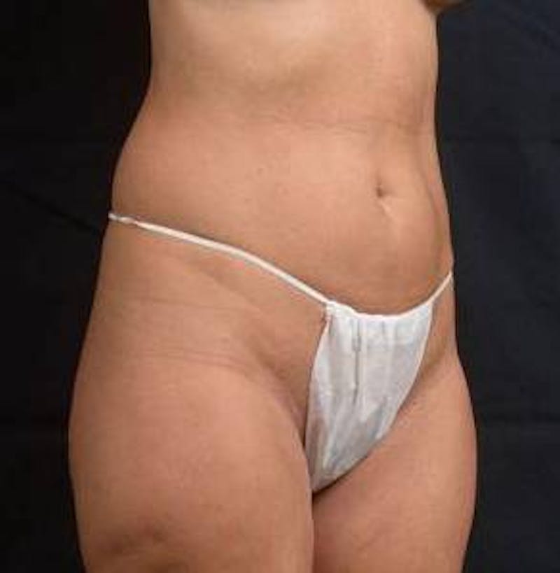 360 Liposuction Before & After Gallery - Patient 305550 - Image 9