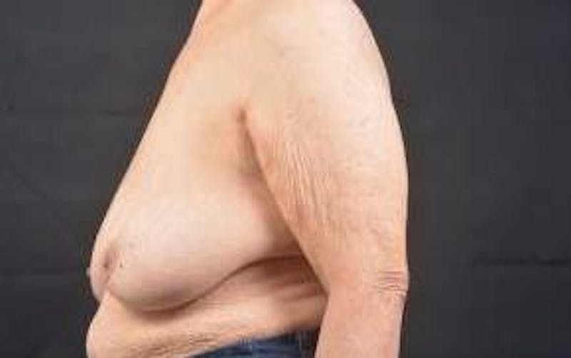 Immediate Breast Reconstruction – Skin Sparing Before & After Gallery - Patient 221455 - Image 3