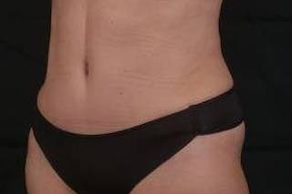 Abdominoplasty Before & After Gallery - Patient 410231 - Image 8