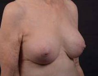 Aesthetic Breast Revision Before & After Gallery - Patient 281728 - Image 10