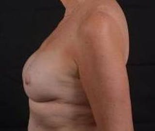 Immediate Breast Reconstruction – Nipple Sparing Before & After Gallery - Patient 118610 - Image 4
