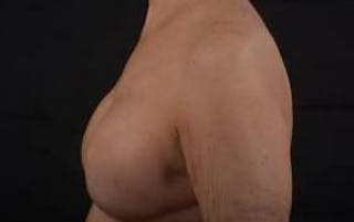 Immediate Breast Reconstruction – Skin Sparing Before & After Gallery - Patient 221455 - Image 4