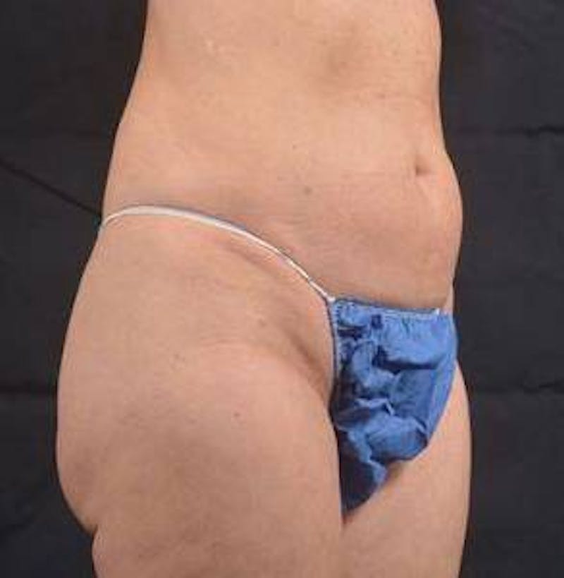 360 Liposuction Before & After Gallery - Patient 305550 - Image 10