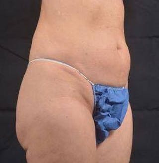 360 Liposuction Before & After Gallery - Patient 305550 - Image 10