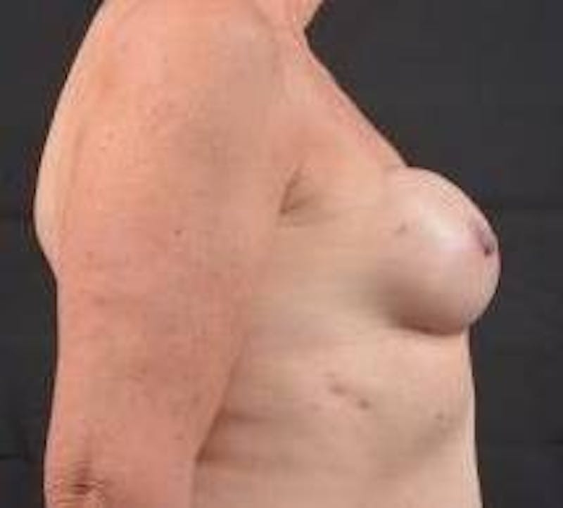 Immediate Breast Reconstruction – Nipple Sparing Before & After Gallery - Patient 118610 - Image 5