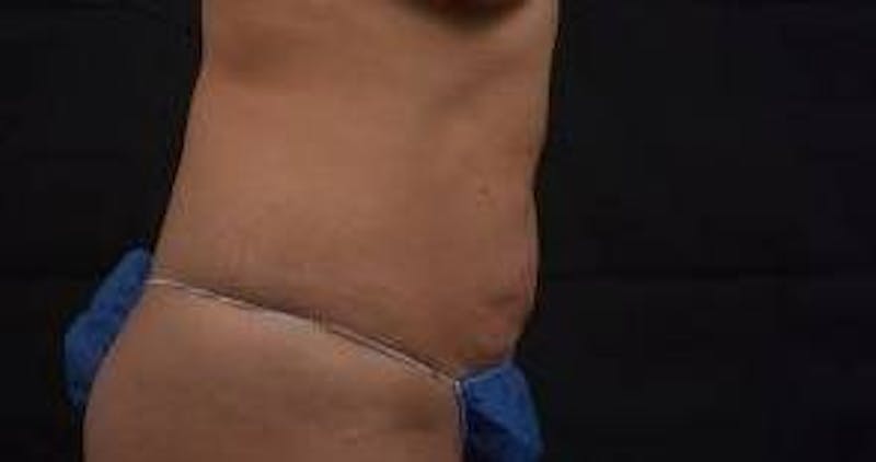 Abdominoplasty Before & After Gallery - Patient 219618 - Image 5