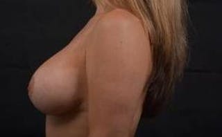 Aesthetic Breast Revision Before & After Gallery - Patient 286019 - Image 4