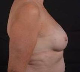 Immediate Breast Reconstruction – Nipple Sparing Before & After Gallery - Patient 118610 - Image 6