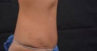 Abdominoplasty Before & After Gallery - Patient 219618 - Image 6