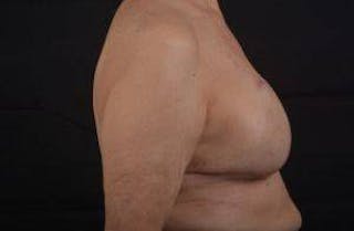 Immediate Breast Reconstruction – Skin Sparing Before & After Gallery - Patient 221455 - Image 6