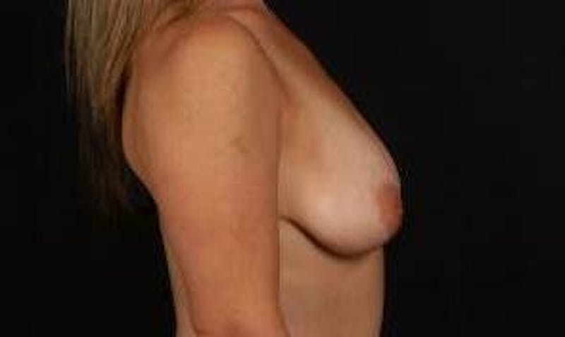 Aesthetic Breast Revision Before & After Gallery - Patient 286019 - Image 5