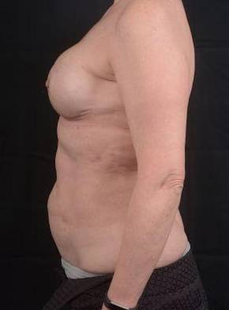 360 Liposuction Before & After Gallery - Patient 225333 - Image 3