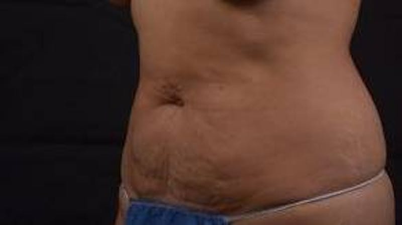 Abdominoplasty Before & After Gallery - Patient 219618 - Image 7