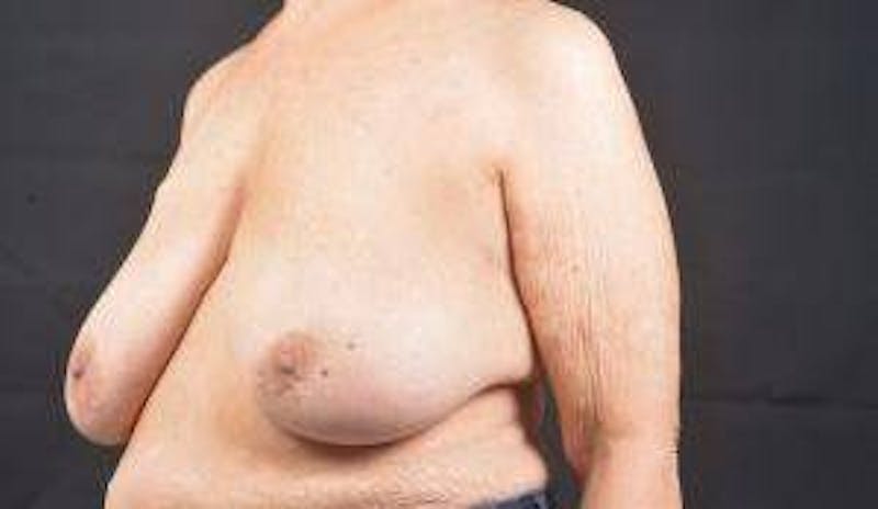 Immediate Breast Reconstruction – Skin Sparing Before & After Gallery - Patient 221455 - Image 7