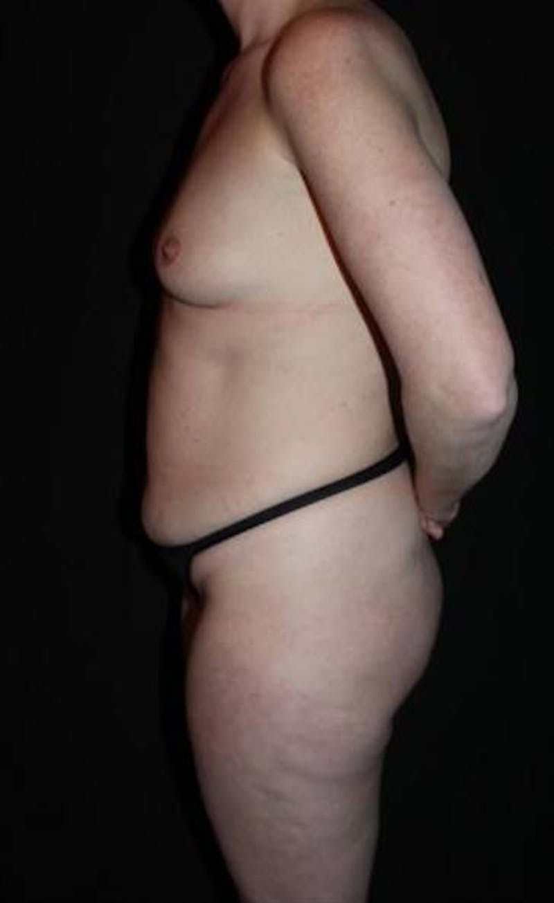 Mommy Makeover Before & After Gallery - Patient 118468 - Image 5
