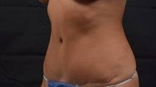 Abdominoplasty Before & After Gallery - Patient 219618 - Image 8