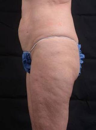360 Liposuction Before & After Gallery - Patient 225333 - Image 4