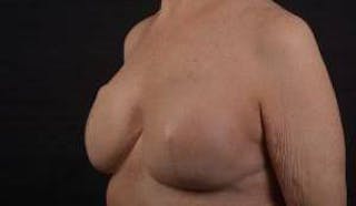 Immediate Breast Reconstruction – Skin Sparing Before & After Gallery - Patient 221455 - Image 8