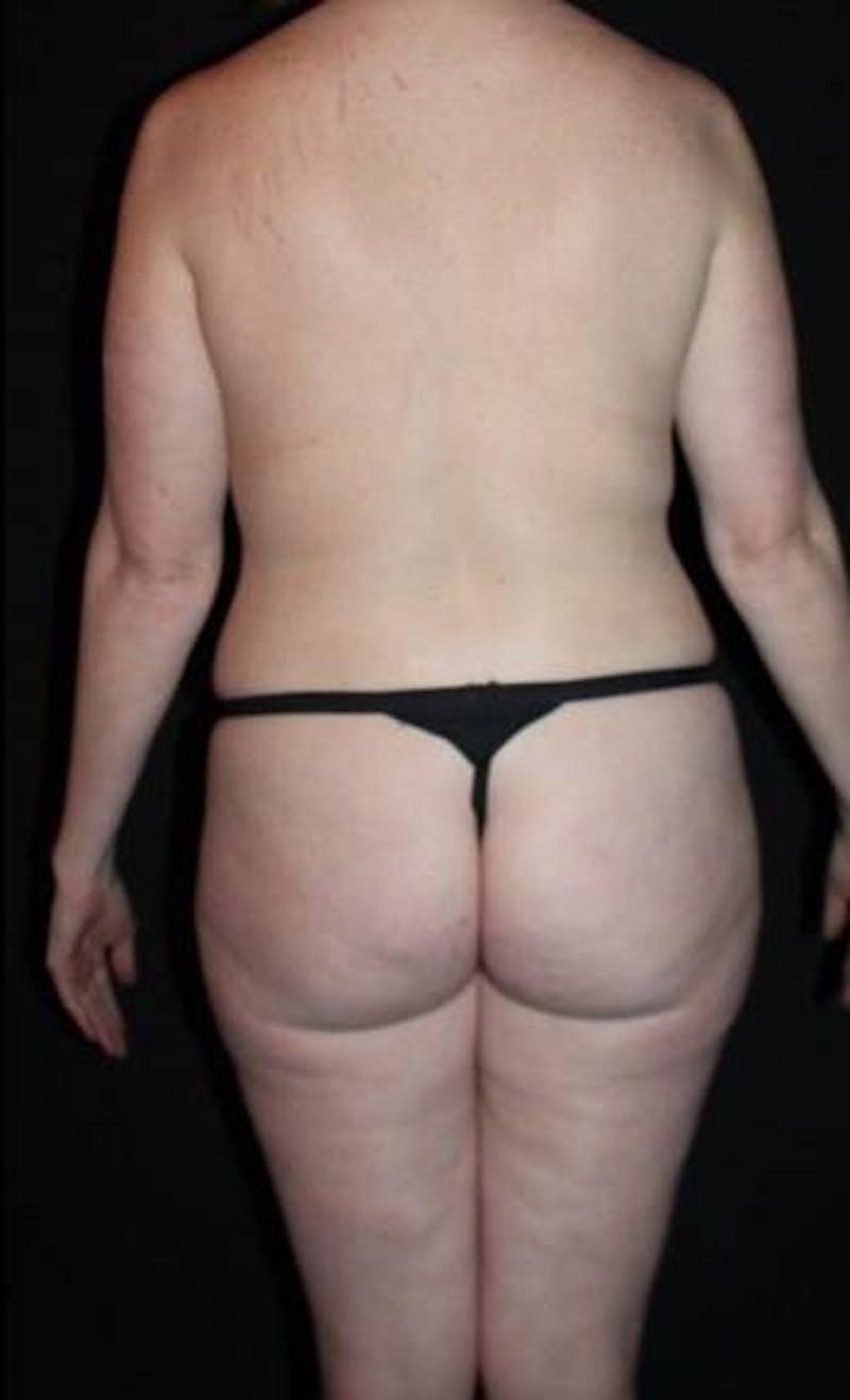 Mommy Makeover Before & After Gallery - Patient 118468 - Image 7