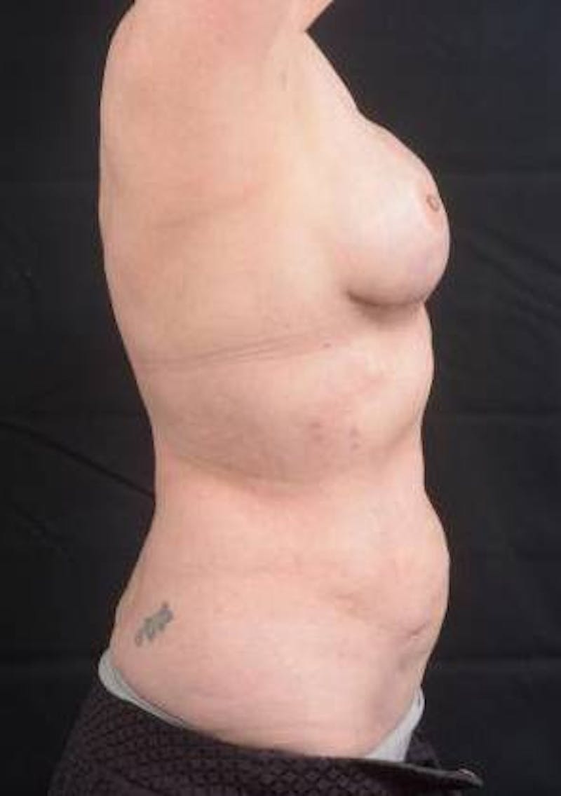 360 Liposuction Before & After Gallery - Patient 225333 - Image 5