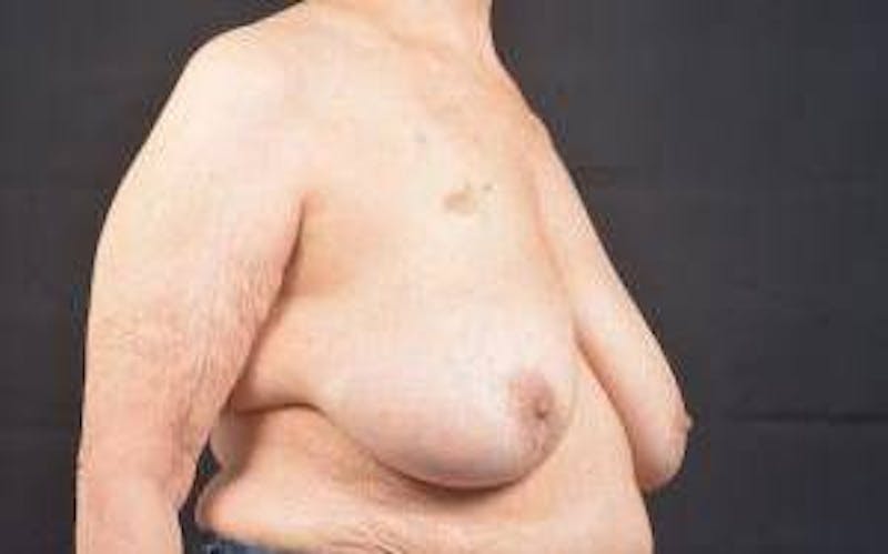 Immediate Breast Reconstruction – Skin Sparing Before & After Gallery - Patient 221455 - Image 9