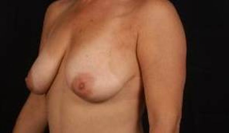 Aesthetic Breast Revision Before & After Gallery - Patient 286019 - Image 7