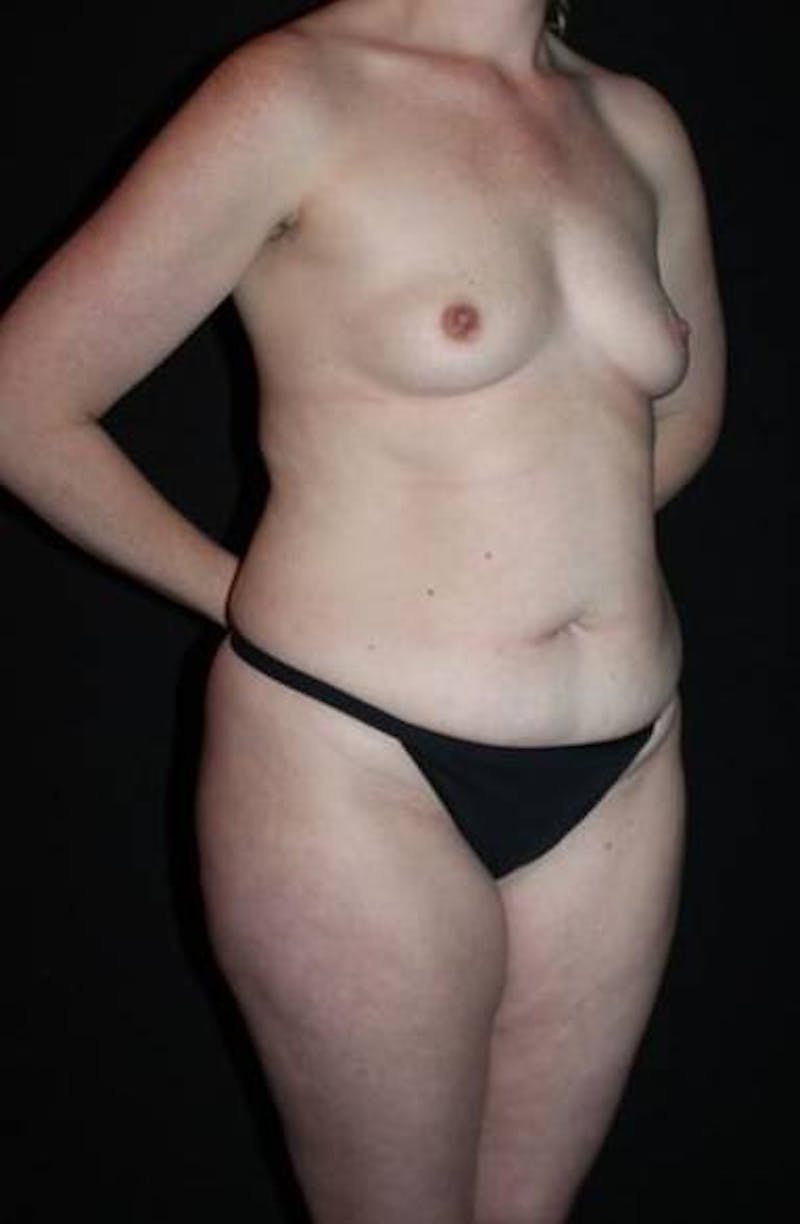 Mommy Makeover Before & After Gallery - Patient 118468 - Image 9
