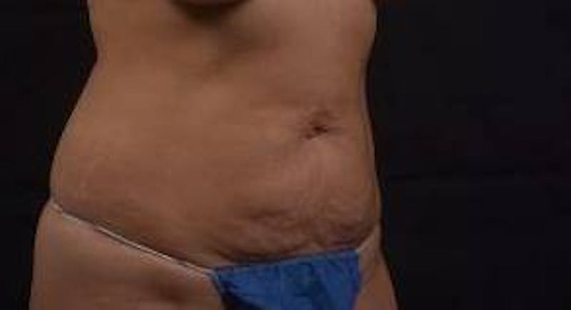 Abdominoplasty Before & After Gallery - Patient 219618 - Image 9