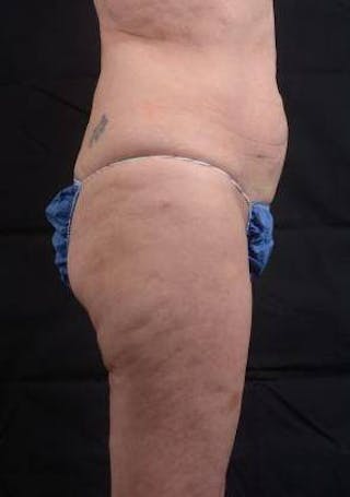 360 Liposuction Before & After Gallery - Patient 225333 - Image 6