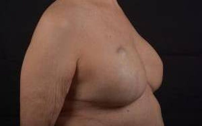 Immediate Breast Reconstruction – Skin Sparing Before & After Gallery - Patient 221455 - Image 10