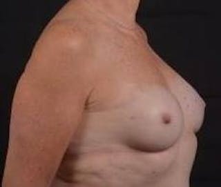 Immediate Breast Reconstruction – Nipple Sparing Before & After Gallery - Patient 118610 - Image 10