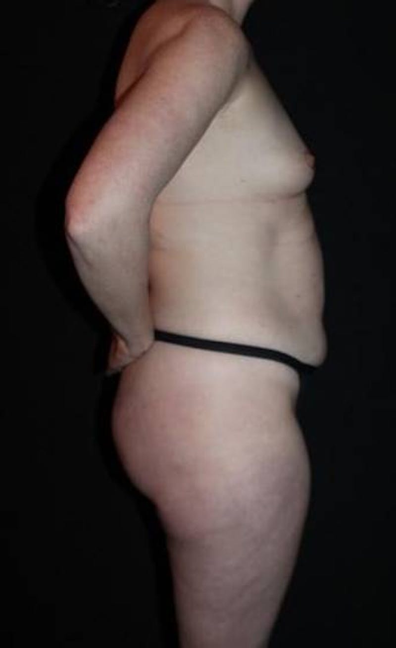 Mommy Makeover Before & After Gallery - Patient 118468 - Image 11