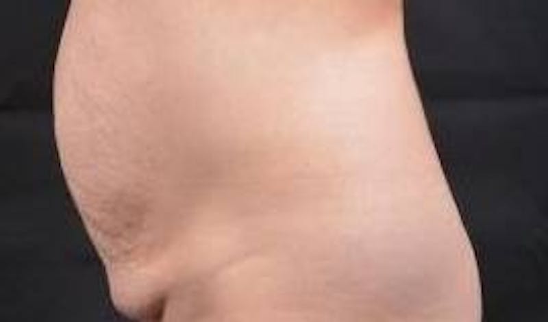 Abdominoplasty Before & After Gallery - Patient 196513 - Image 3