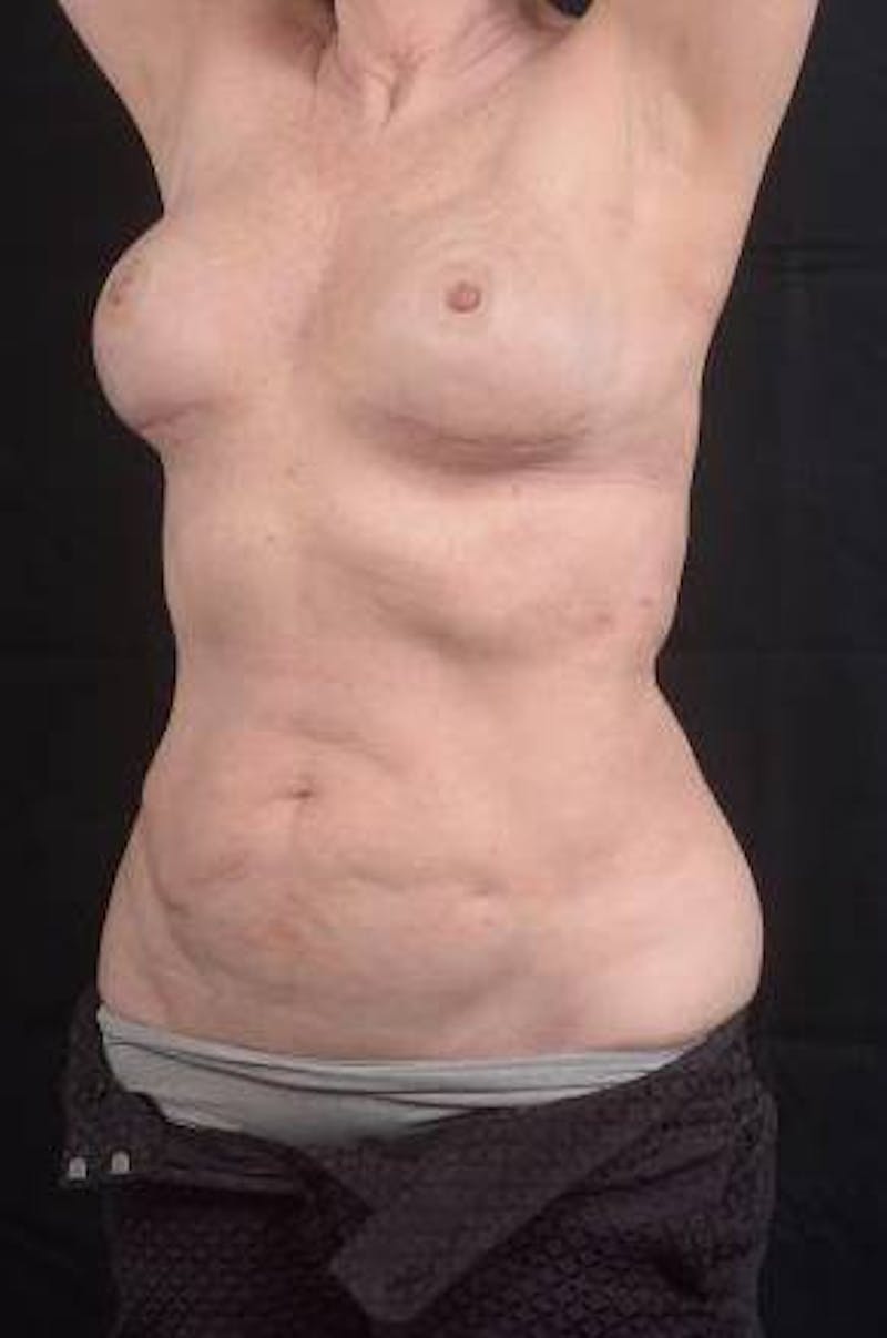 360 Liposuction Before & After Gallery - Patient 225333 - Image 7