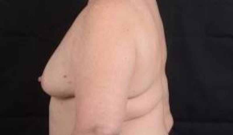 Immediate Breast Reconstruction – Skin Sparing Before & After Gallery - Patient 381662 - Image 3