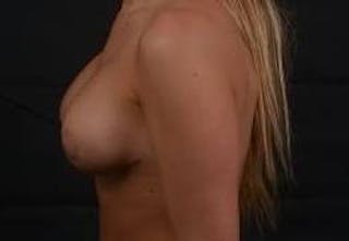 Breast Augmentation Mastopexy Before & After Gallery - Patient 216324 - Image 4