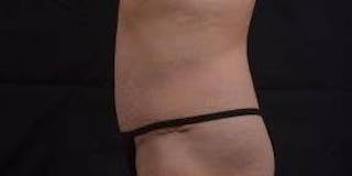 Abdominoplasty Before & After Gallery - Patient 196513 - Image 4