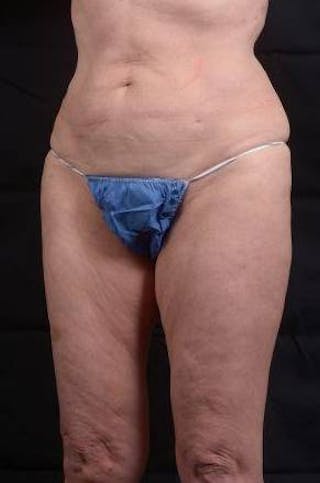 360 Liposuction Before & After Gallery - Patient 225333 - Image 8