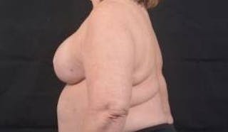 Immediate Breast Reconstruction – Skin Sparing Before & After Gallery - Patient 381662 - Image 4